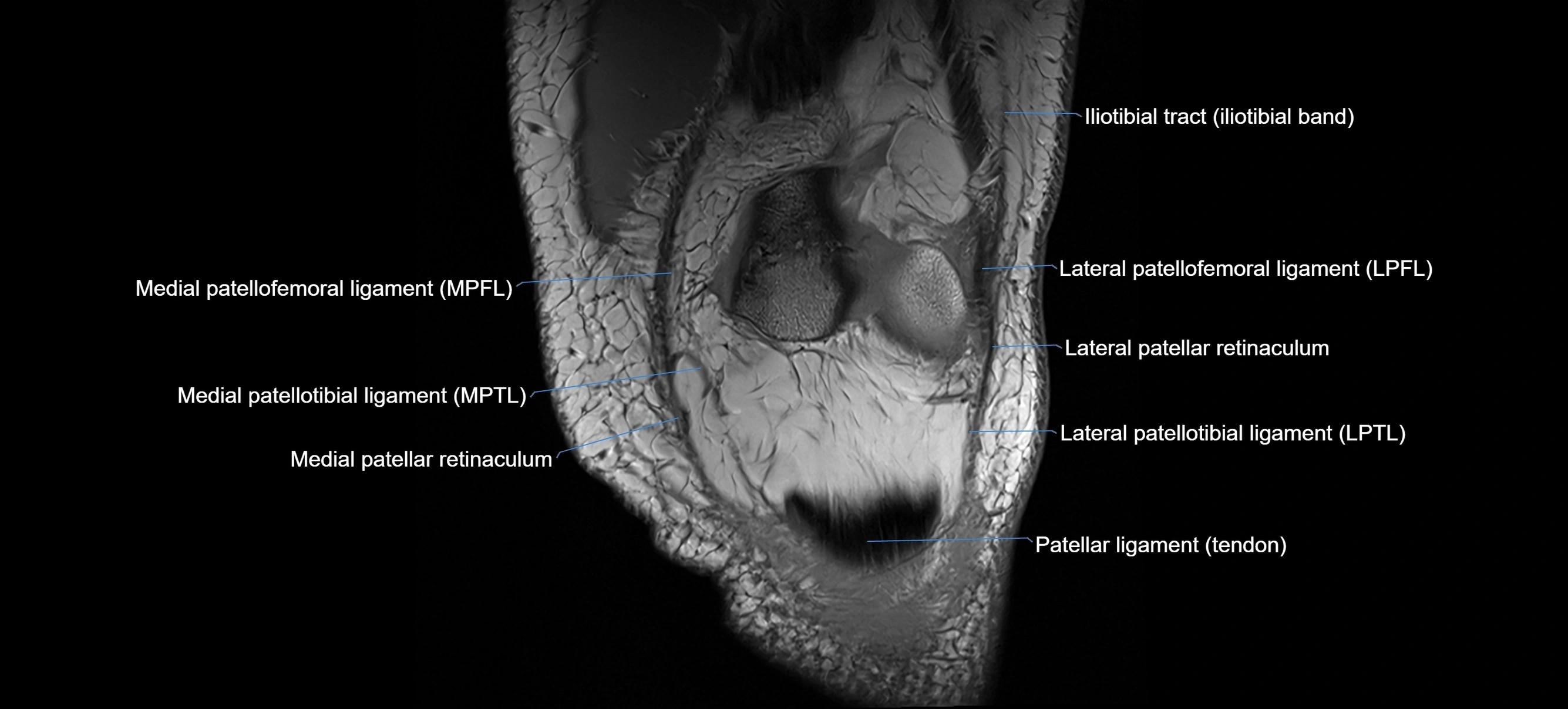 MRI coronal  ligaments cross sectional anatomy 3T  radiology  image-img-04001-00008.webp